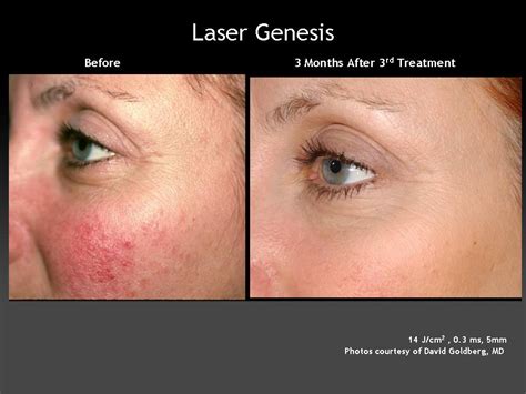 Laser Genesis - Tamra Bedford, Cosmetic RN (925) 518-5212