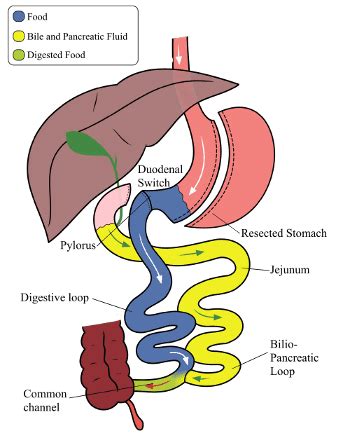 Gastric Bypass vs Duodenal Switch: Choose the Right Surgery