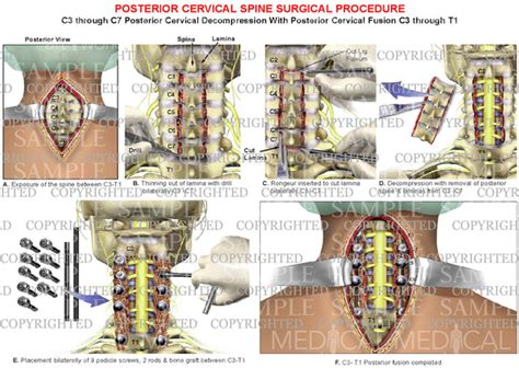 4 level - C3-C7 cervical spine decompression surgical procedure ...