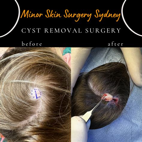 Cyst Surgery, Cyst Removal, Cyst Treatment Sydney