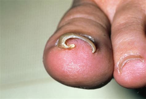 Ingrown Toenail Infection Pictures ~ Ingrown Toenail