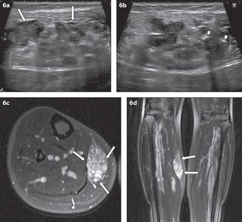 Hemangioma Mri