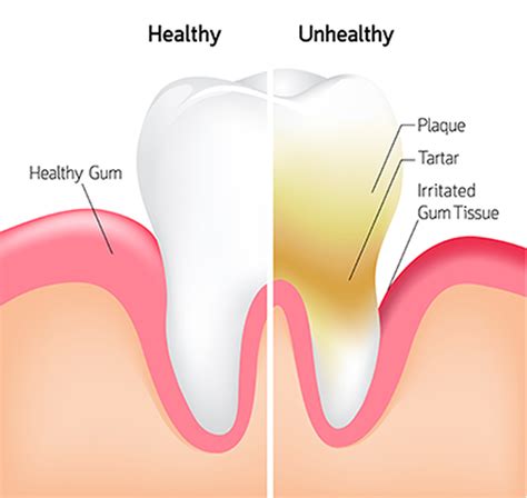 What is Plaque & Tartar | Calgary | Ti Dental