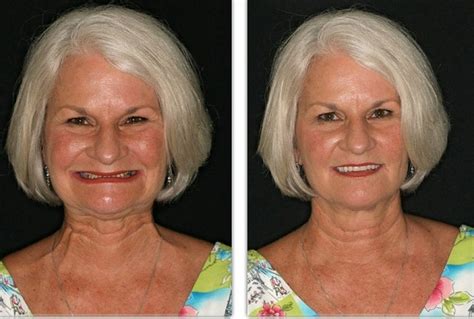 Dentures — Dr. Rick Coker's Smile Studio - Premier Cosmetic Dentistry