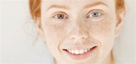 Heterochromia: Causes And Types | Vision Source of Hendersonville