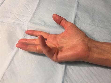 Pictures of Dupuytrens Disease Hands - John Erickson, MD