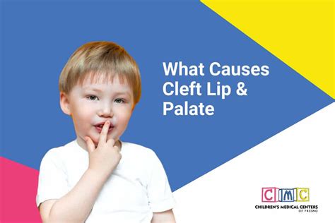 What Causes Cleft Lip & Palate | Children's Medical Centers of Fresno