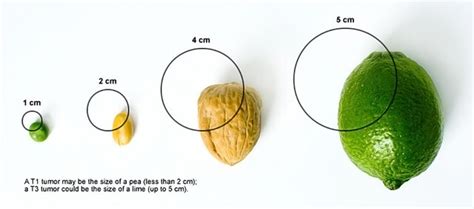 Tumor Size Centimeters: Image Details NCI Visuals Online, 57% OFF