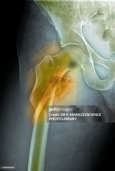 Hip Fracture Xray High-Res Stock Photo - Getty Images