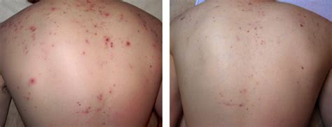 Acne Pictures - Before and After, Pictures of Acne | Acne Photos ...