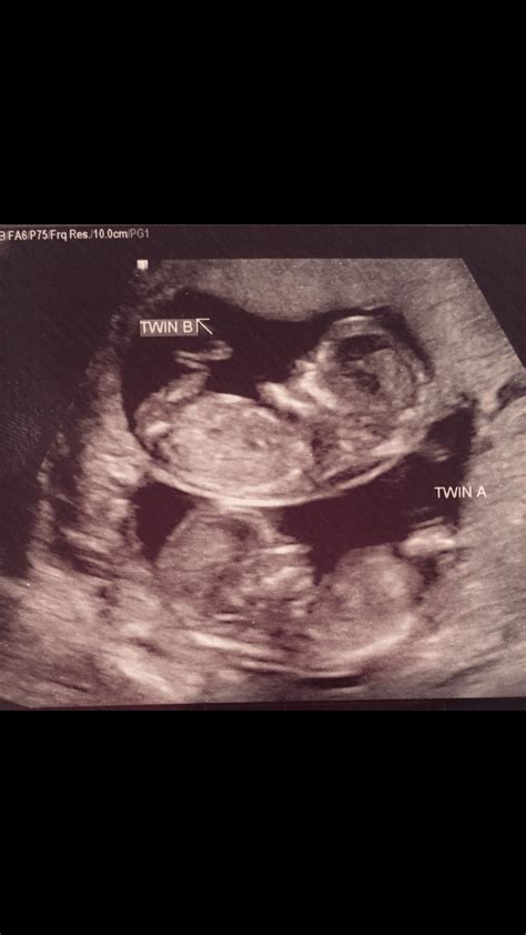 12 Weeks Pregnant Ultrasound