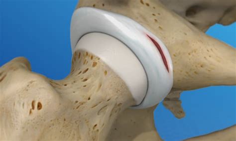 What is a Hip Labral Tear? - Dr. J RichardEvanson