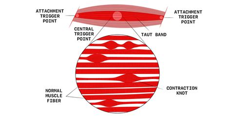 Calf Muscle Knots - All You Need to Know About These Painful Lumps ...