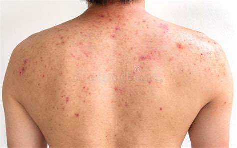 Men with Acne, with Red Spots on the Back Stock Photo - Image of ...