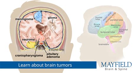 Brain tumors: overview of types, diagnosis, treatment options ...