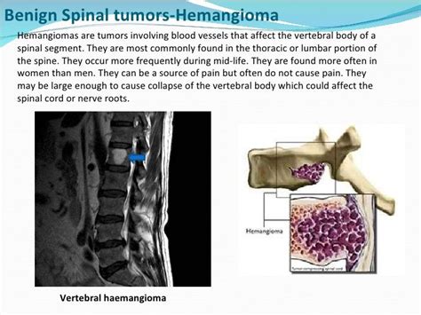 10 best Hemangioma images on Pinterest | Medical, Breastfeeding and ...