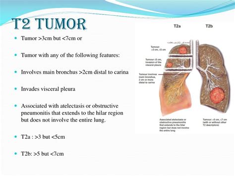 PPT - Lung cancer staging PowerPoint Presentation, free download - ID ...