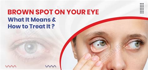 Brown Spot on Your Eye: What It Means and How to Treat It