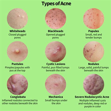 All About Acne Part 1: The Causes