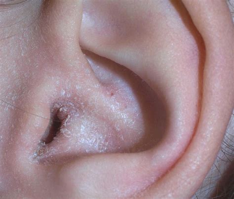 Dry Flaky Skin In Ear Canal | Diydrywalls.org