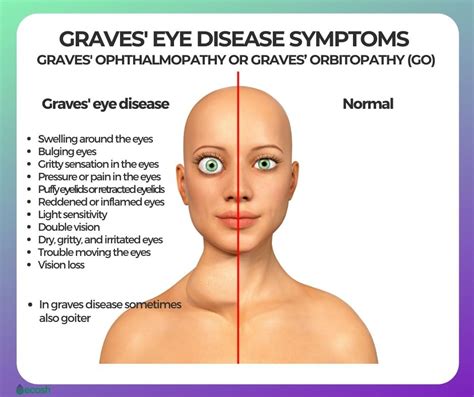 GRAVES' EYE DISEASE (GRAVES' OPHTHALMOPATHY OR GRAVES’ ORBITOPATHY (GO ...