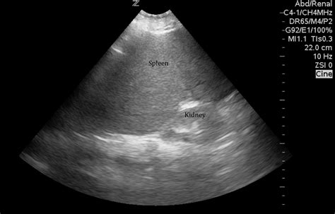 Abnormal Spleen Ultrasound