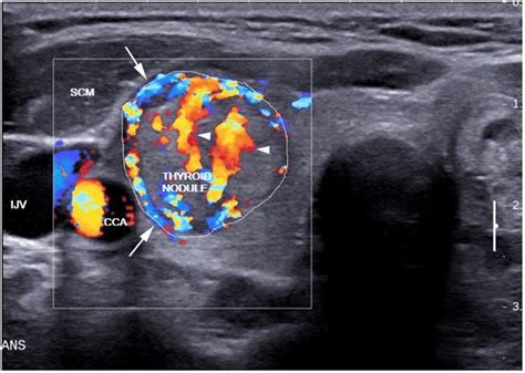 Thyroid Cancer Ultrasound