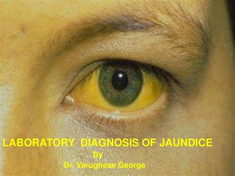 Laboratory Diagnosis of Jaundice