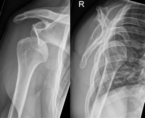 File:Dislocated shoulder X-ray 11.png