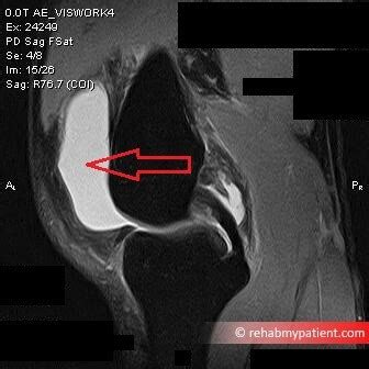 Knee Bursitis | Rehab My Patient