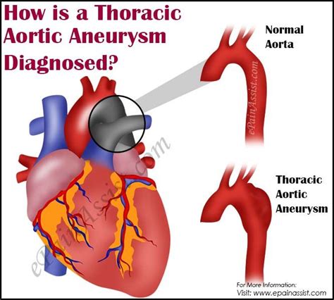 Thoracic Aortic Aneurysm Diagnosis | Supply of Science