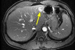 TJUH Liver Hemangioma Ð MRI