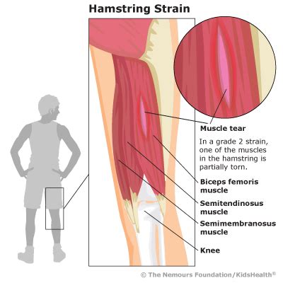 Hamstring Strain (for Teens) - Seattle Children's Hospital