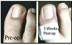 Ingrown Toenail Surgery Hobart | A Cure for Ingrown Toenails, Call Today