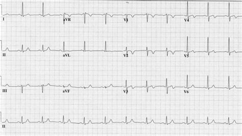 Wellens syndrome definition, diagnostic criteria, causes, symptoms ...