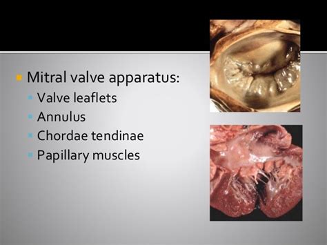 Cardiology - Myxomatous Mitral Valve Degeneration: What's New? By Rit…