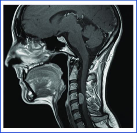 Sagittal preoperative MRI of the cervical spine with contrast ...