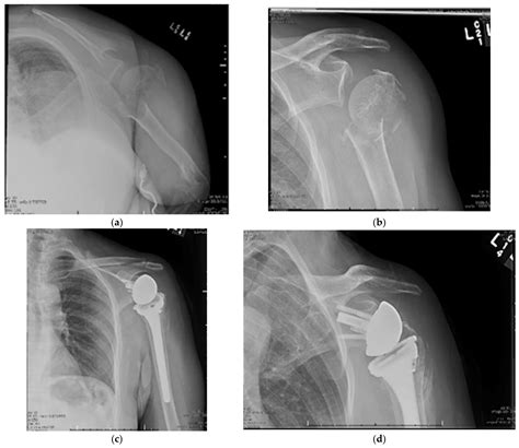 JCM | Free Full-Text | Management of Proximal Humerus Fractures in ...