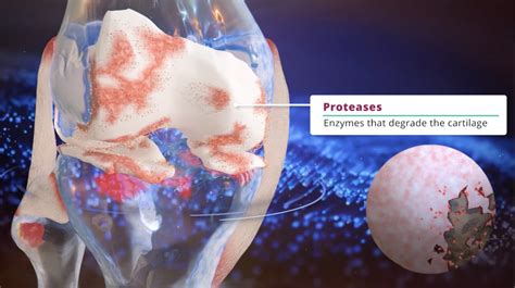 Knee Cartilage Regeneration - case study - Nanobotmedical