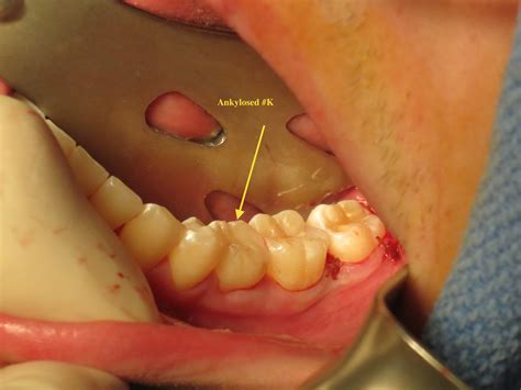 Management of ankylosed primary molars with premolar successors, aka ...