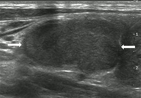 Follicular Thyroid Cancer Ultrasound