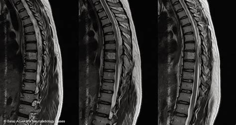 HEMANGIOMA SPINE MRI T1 T2 - Wroc?awski Informator Internetowy - Wroc ...