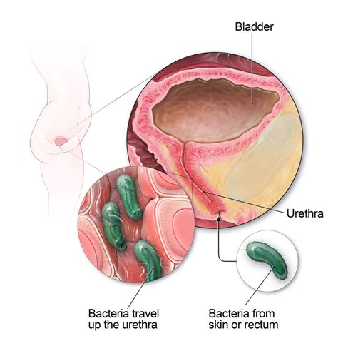 Get Smart About Antibiotics | Urinary Tract Infection | CDC