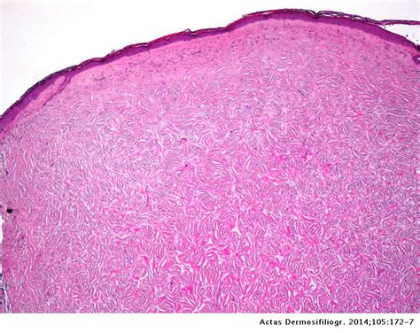 Dermatofibroma of the Face: A Clinicopathologic Study of 20 Cases ...