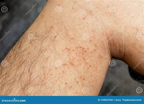 Skin Disease Winter Healthcare Dry Cracking Skin And Rash Red Of Leg