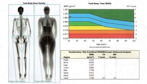 OsteoStrong Mobile | Hillcrest How to Read Your Dexa Scan Results