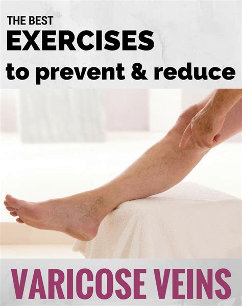 The Best Exercises for Varicose Veins | Top Varicose Vein Treatment NYC