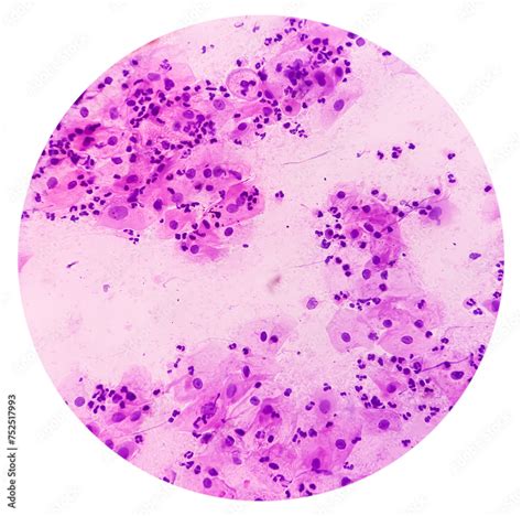 Cervical cancer cells. Atypical squamous cells of undetermined ...