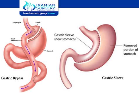 Modified Duodenal Switch Diet | Iranian Surgery