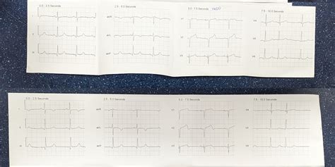 Is this Wellen's Syndrome Pattern A? : r/EKGs